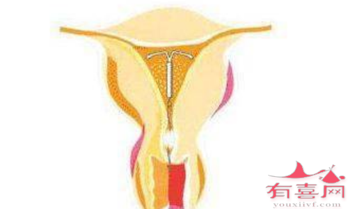 澳门助孕生子费用-服用甘露醇治疗子宫腺肌症的优缺点。