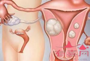 合肥助孕信息：什么样的女人容易得子宫肌瘤