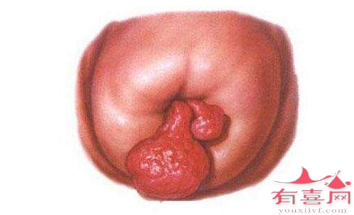 福州助孕公司信息：有宫颈息肉能怀孕吗？