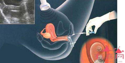 保定借卵试管助孕群：一般情况下，做完2次人工授精就能怀孕吗？