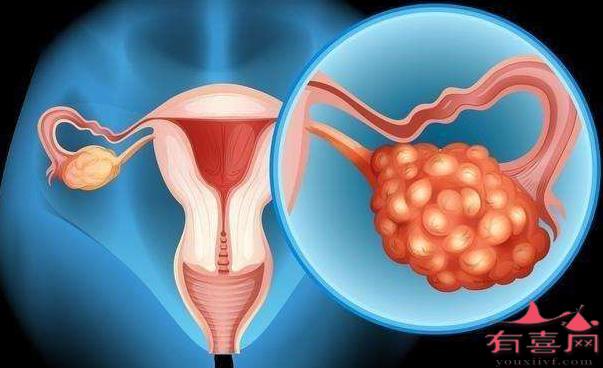 青岛56岁助孕中介-患有多囊卵巢综合症如何怀孕