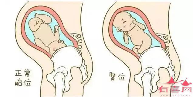 九江试管助孕生殖中心：十个臀位呈现中有九个发生在女孩身上，这是真的吗？