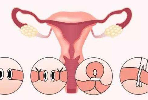 嘉兴捐卵-即使双侧输卵管被切除，你也可以怀孕，而且除了人工授精，还有很多治疗方案。